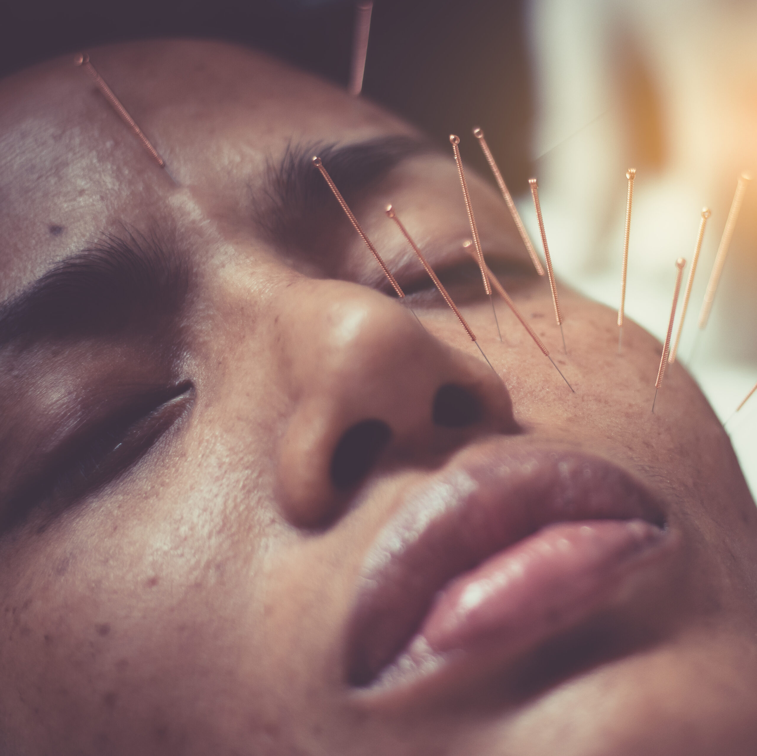 Is Facial Acupuncture The Answer To Younger-Looking Skin?