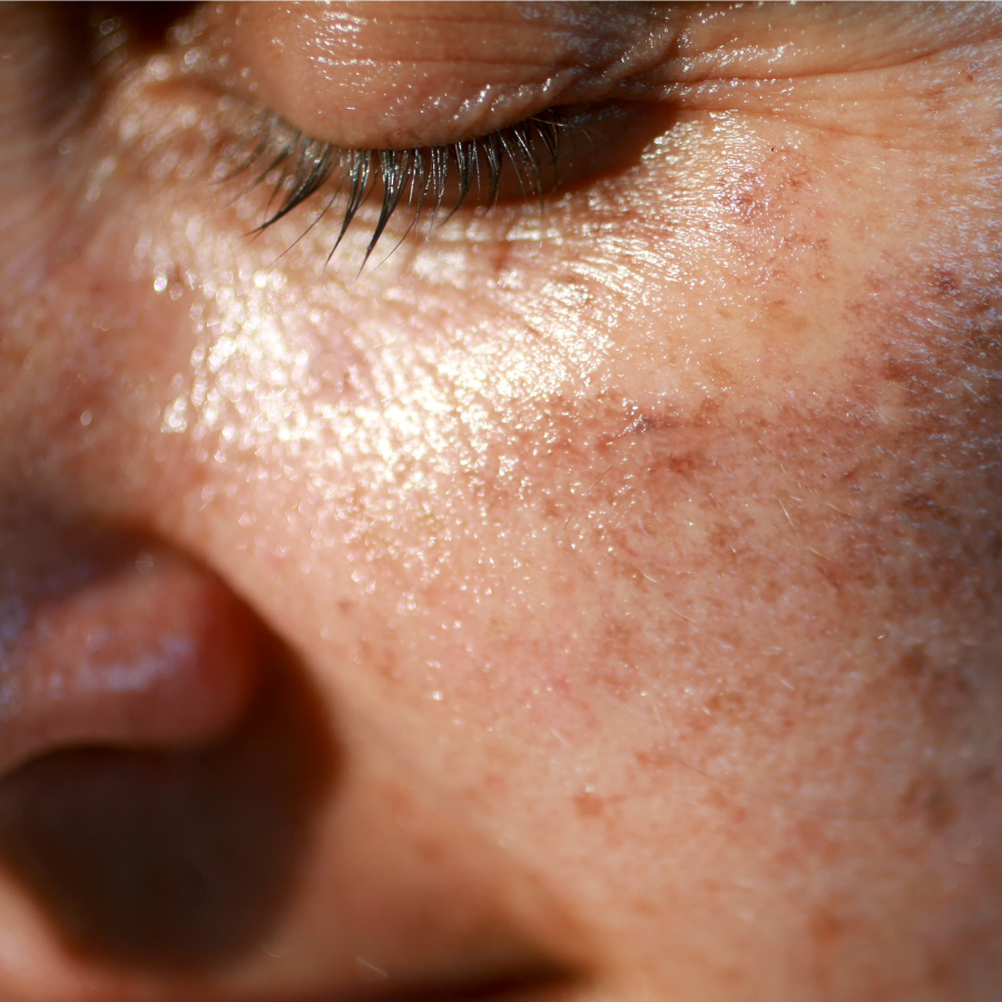 How To Treat Pigmentation According To Kate Moss’ Facialist