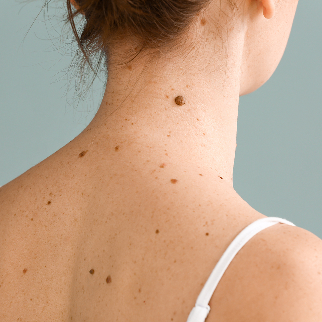 How To Keep An Eye On Your Moles This Summer