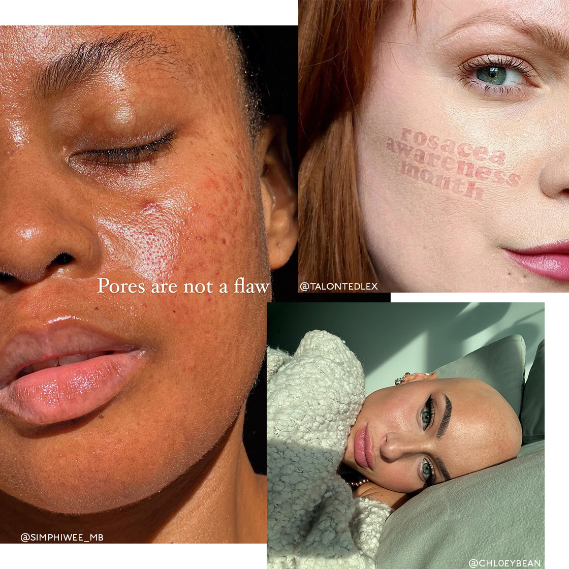 10 Influencers Embracing Skin Positivity