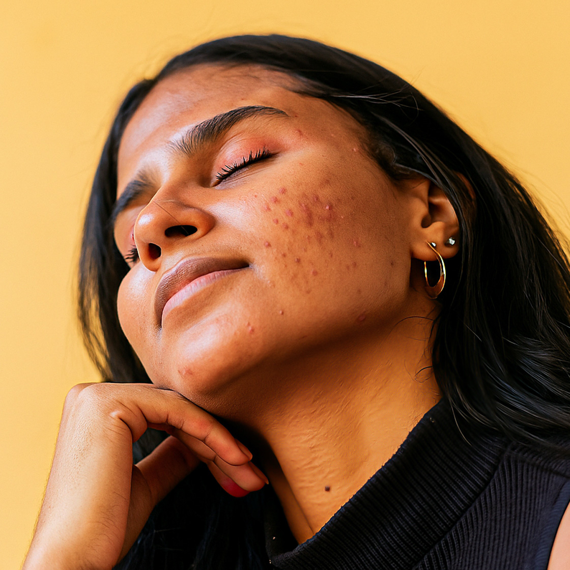 How To Effectively Treat + Manage Adult Acne