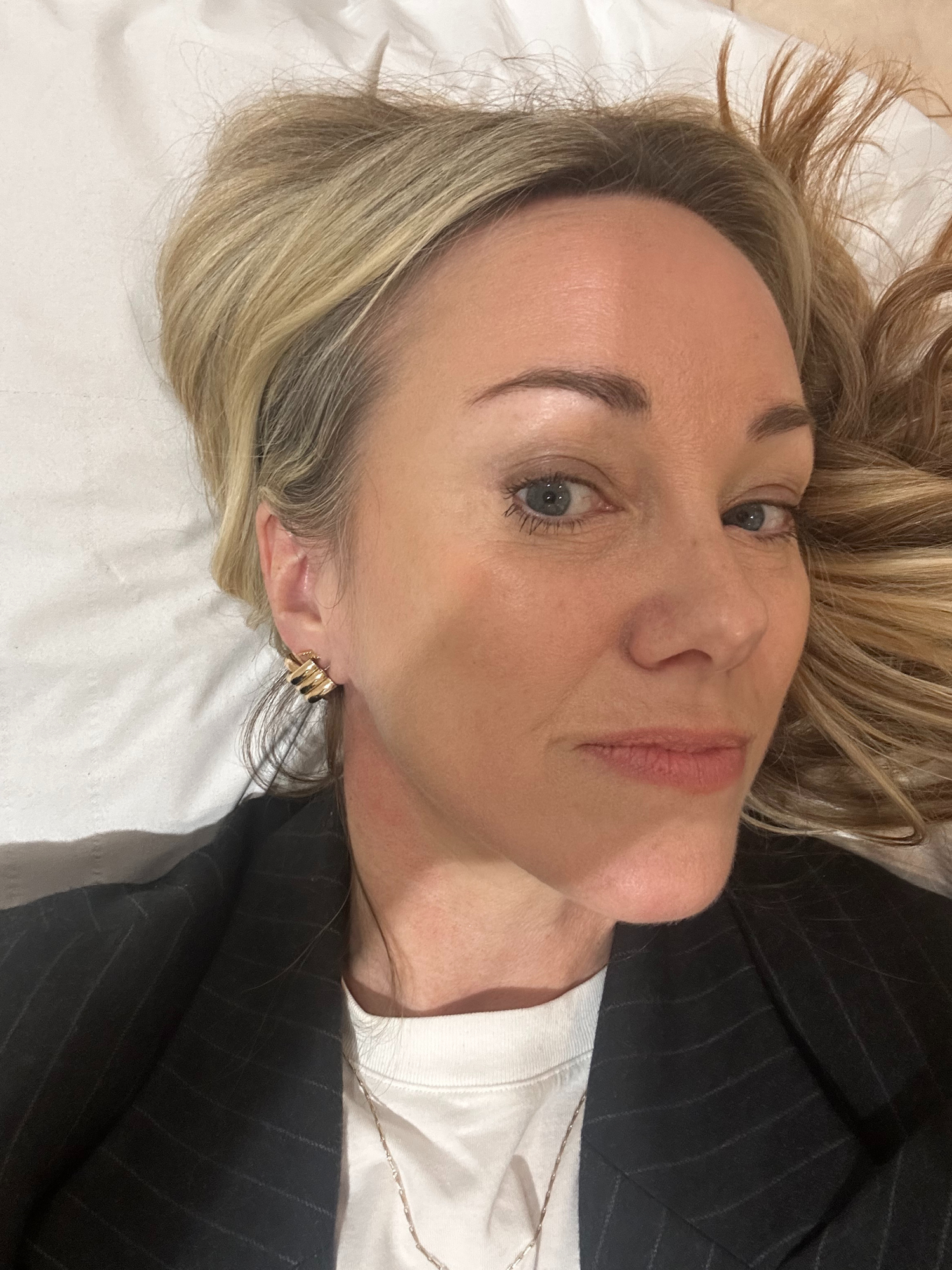 pico laser treatment